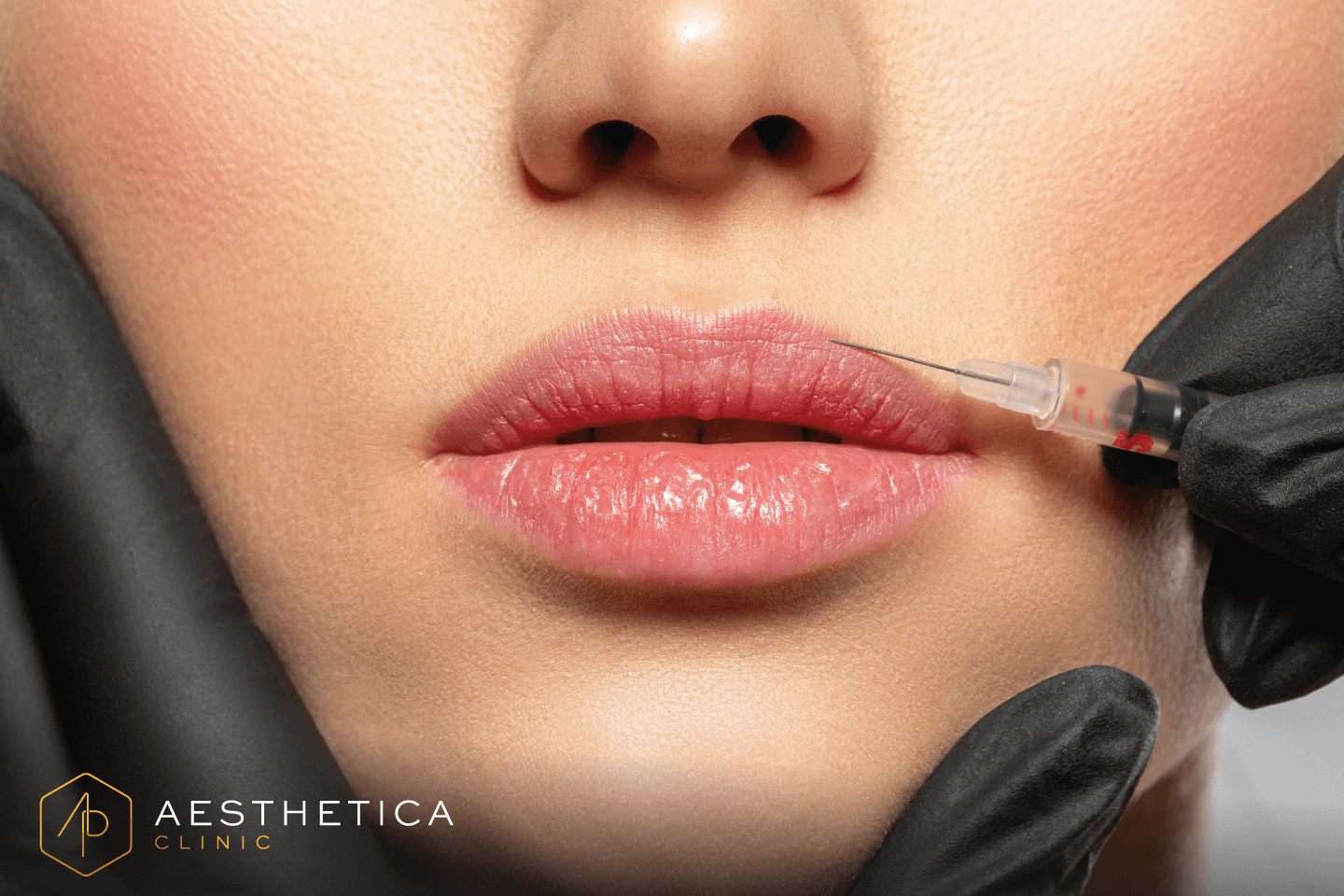 Dermal fillers
